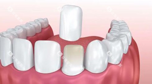 卡通图示意牙贴面改善