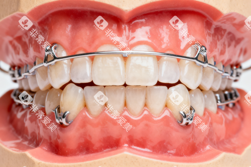 牙齿保持器模型展示图