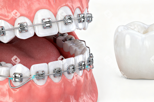 牙齿矫正卡通展示图