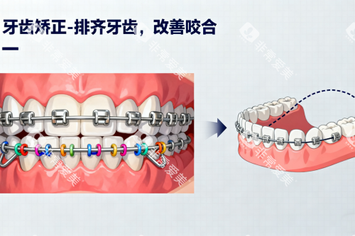 金属牙齿矫正卡通展示图 金属牙齿矫正卡通展示图