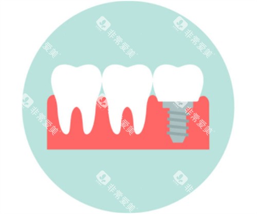 种植牙模拟卡通图
