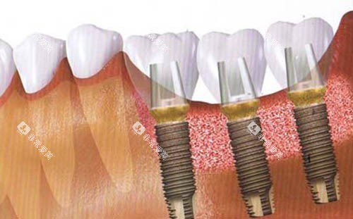 种植牙手术后图