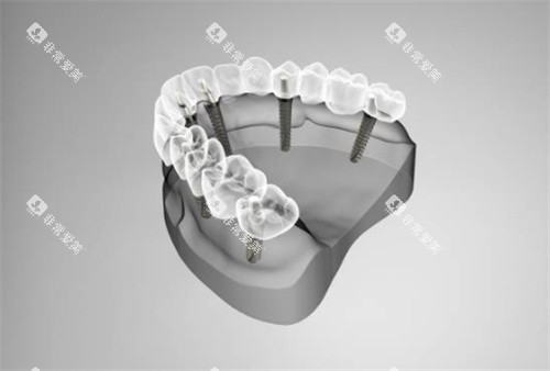 半口种植牙模拟示意图