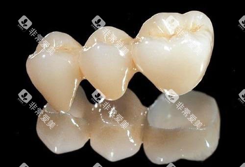 三科联排全瓷牙冠
