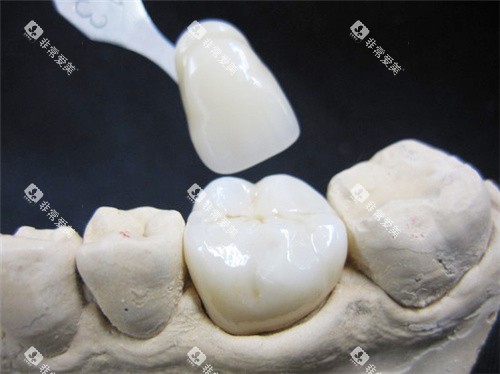 lava全瓷牙 lava全瓷牙