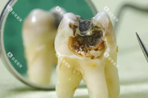 牙齿从根部开始烂图片