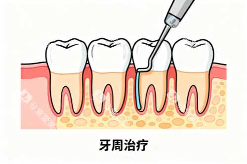 牙周治疗卡通图
