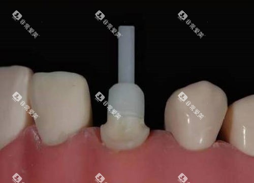 牙齿打桩流程