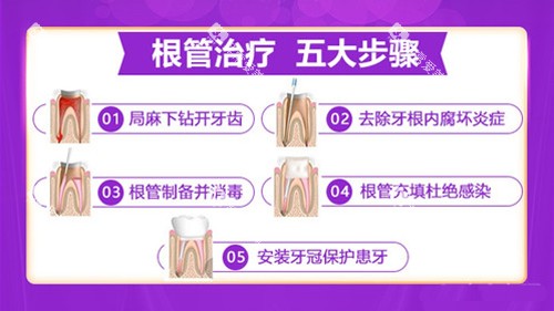 根管治疗的步骤