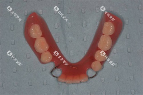 半口可摘局部义齿实物展示图