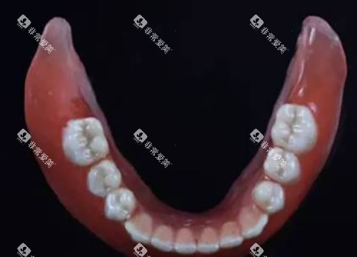 吸附性全口义齿