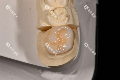 西诺德全瓷牙咬合面展示