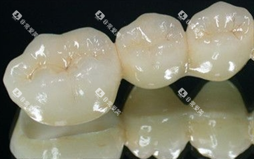 全瓷牙模型展示