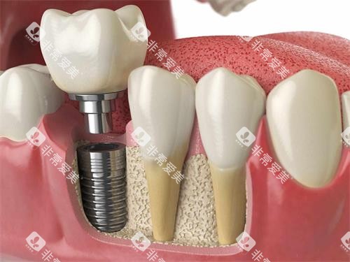 种牙图片