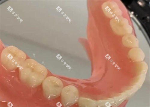 半口固定假牙模型展示
