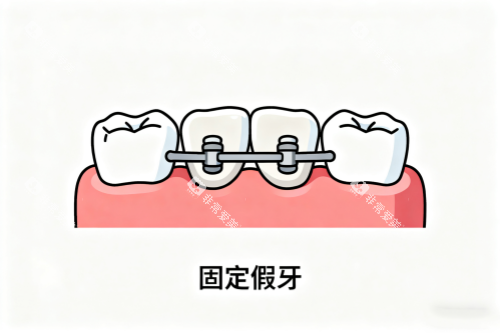 固定假牙卡通展示图