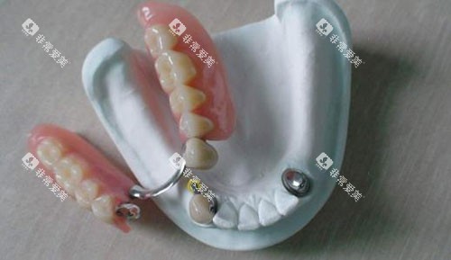 活动假牙半口展示