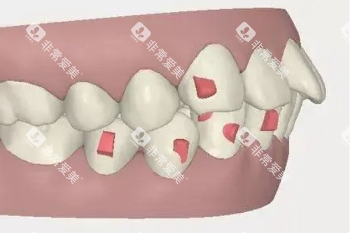 牙齿突出卡通图 牙齿突出卡通图