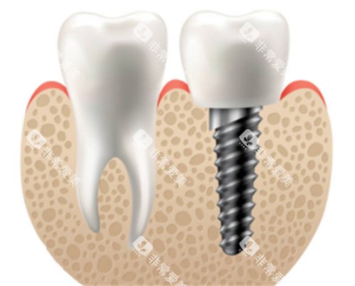 种植牙和正常牙对比图 种植牙和正常牙对比图