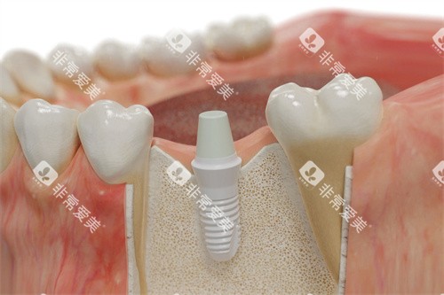 德国SKY种植牙植入模拟图