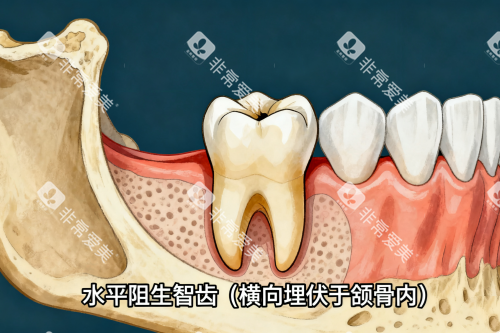 水平阻生智齿一览