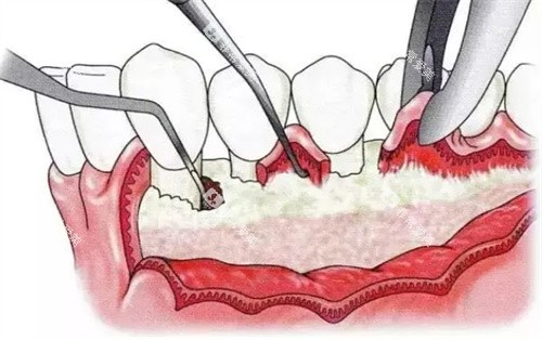 牙周炎翻瓣手术全过程 牙周炎翻瓣手术全过程