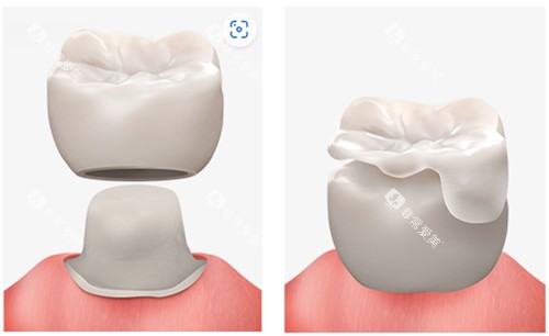 补牙图示 补牙图示