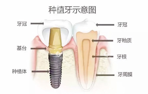 种植牙示意图