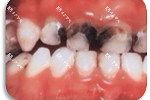 牙根龋坏图片 牙根龋坏图片