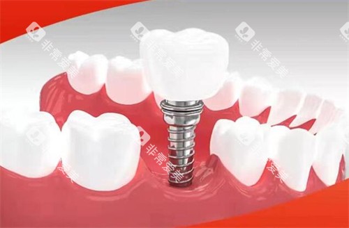 赣州金铂利口腔种植牙 赣州金铂利口腔种植牙