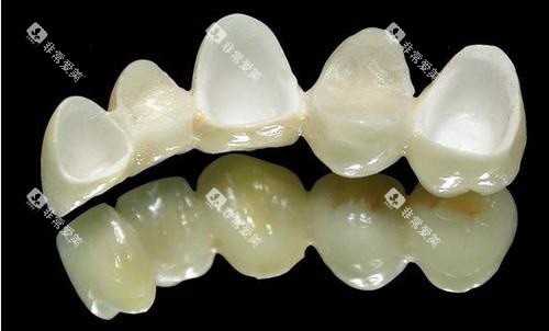 半口全瓷牙展示