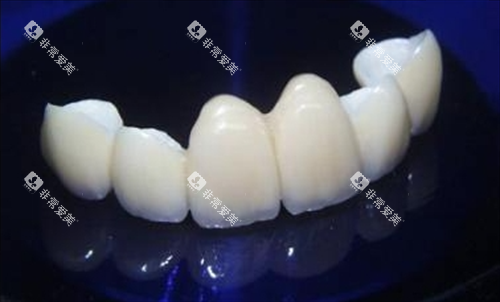 则武全瓷牙联冠展示