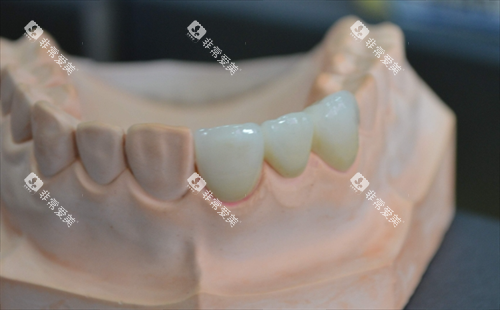 安装在牙齿模型上的全瓷牙成效 安装在牙齿模型上的全瓷牙成效