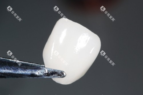 牙贴面材料展示图 牙贴面材料展示图