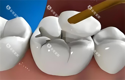 补牙动画 补牙动画