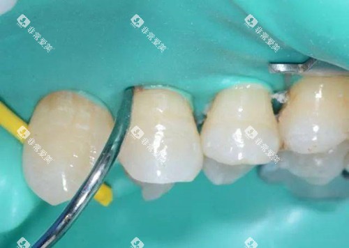 橡皮障在补牙中的运用 橡皮障在补牙中的运用