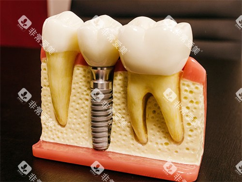 种植牙模型图
