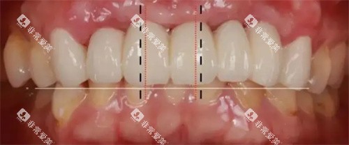 牙齿修复数据测量 牙齿修复数据测量