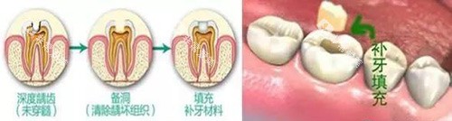 补牙过程展示 补牙过程展示