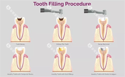 补牙过程图 补牙过程图
