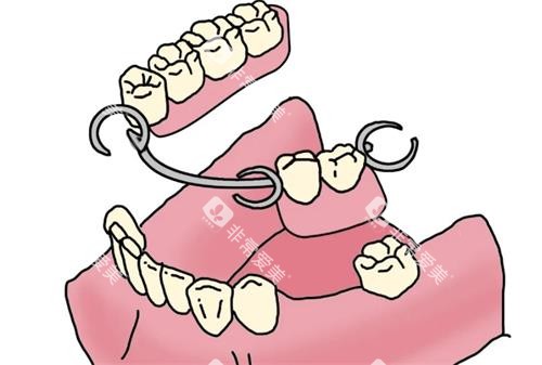 活动义齿动画图