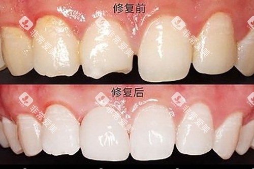 牙齿贴面对比示意图 牙齿贴面对比示意图