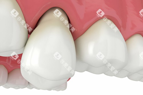牙齿松动模型图 牙齿松动模型图