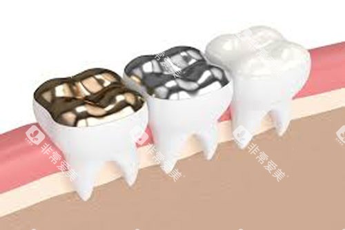 金属嵌体镶牙示意图 金属嵌体镶牙示意图