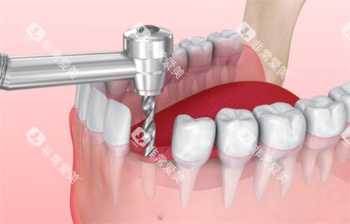 种植牙过程动画展示