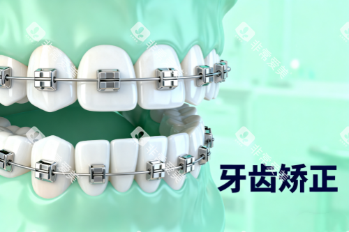 传统牙齿矫正方式展示 传统牙齿矫正方式展示