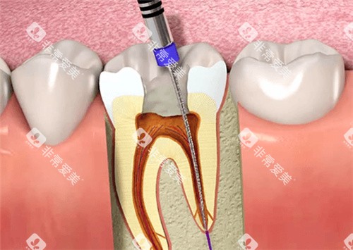 牙齿根管治填充 牙齿根管治填充