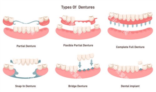 牙齿缺失示意图 牙齿缺失示意图