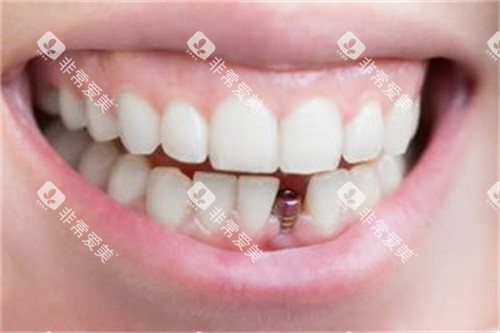正在做种植的牙齿 正在做种植的牙齿