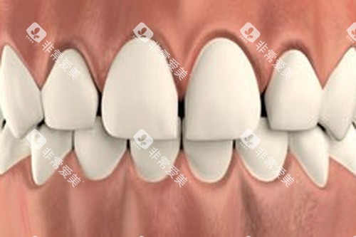 牙齿稀疏示意图